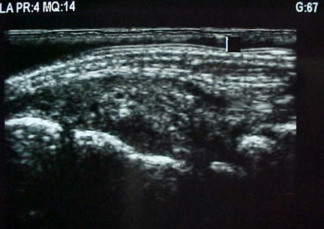 Figure 2 for case Psoriatic arthritis on the wrist